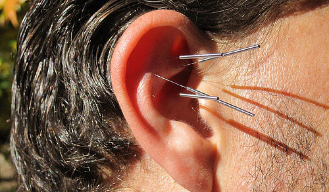 Bisakah Terapi Akupunktur Untuk Gangguan Pendengaran?
