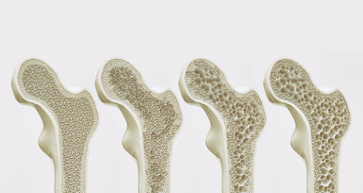 Memahami Hubungan Antara Osteoporosis dan Gangguan Pendengaran