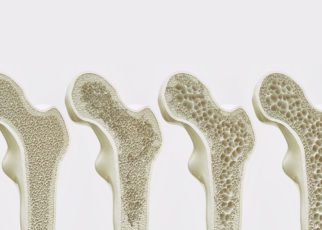 Memahami Hubungan Antara Osteoporosis dan Gangguan Pendengaran